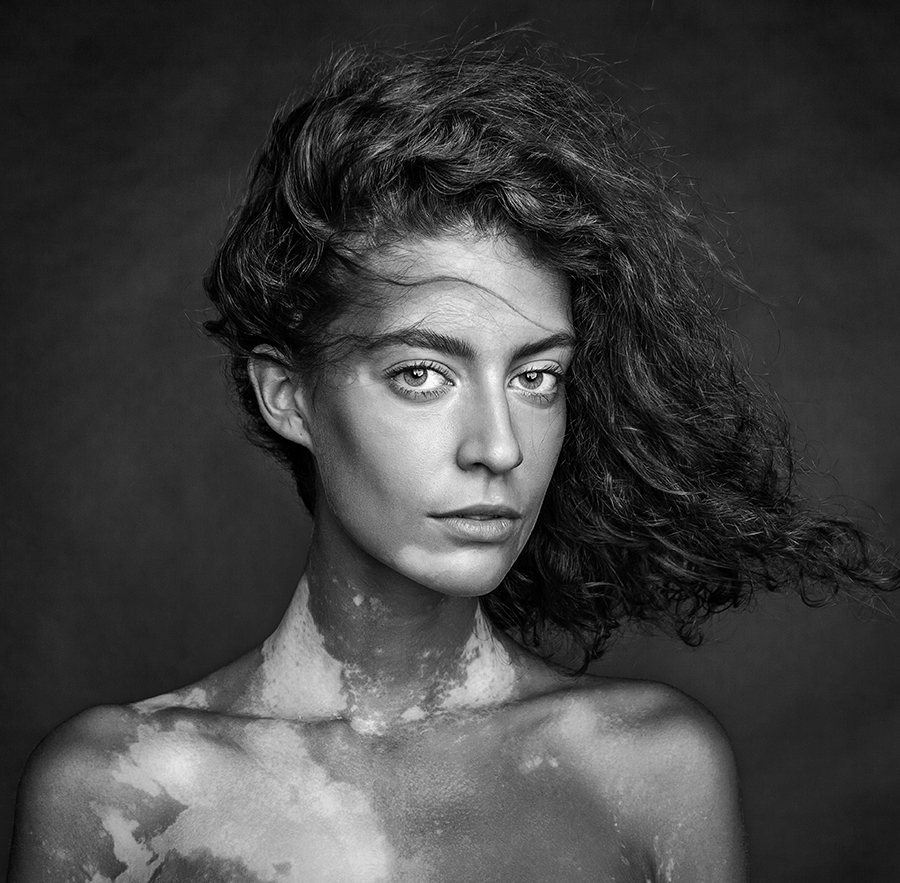 Girl with vitiligo