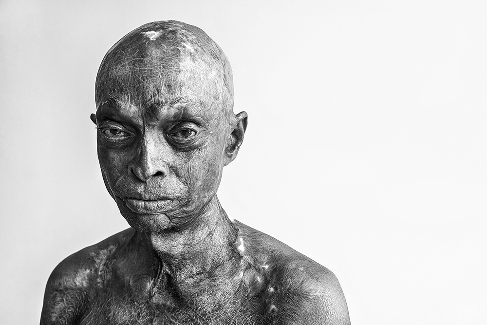 Bidhan / acid attack survivor