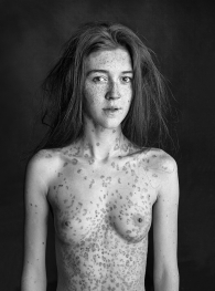 Girl with Psoriasis